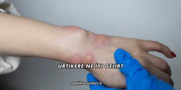 Ürtikere Ne İyi Gelir?