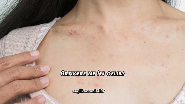 Ürtikere Ne İyi Gelir?