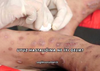 Uyuz Hastalığına Ne İyi Gelir?