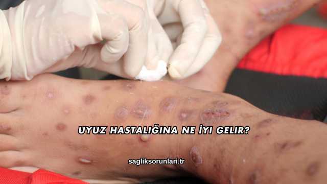 Uyuz Hastalığına Ne İyi Gelir?