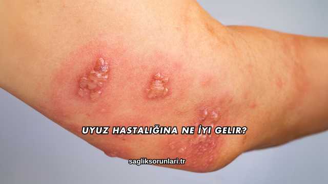 Uyuz Hastalığına Ne İyi Gelir?