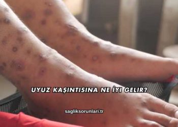 Uyuz Kaşıntısına Ne İyi Gelir?