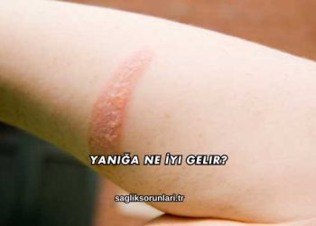 Yanığa Ne İyi Gelir?