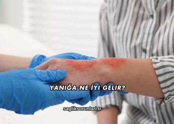 Yanığa Ne İyi Gelir?