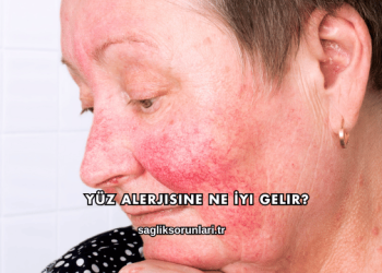 Yüz Alerjisine Ne İyi Gelir?