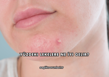 Yüzdeki Lekelere Ne İyi Gelir?