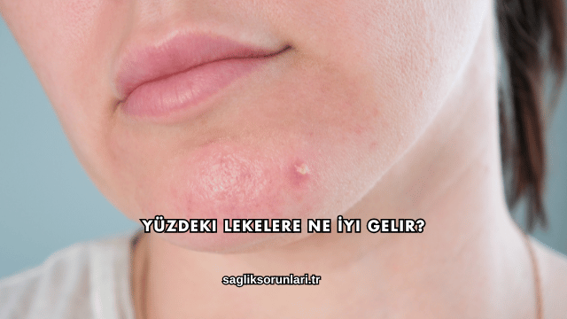 Yüzdeki Lekelere Ne İyi Gelir?