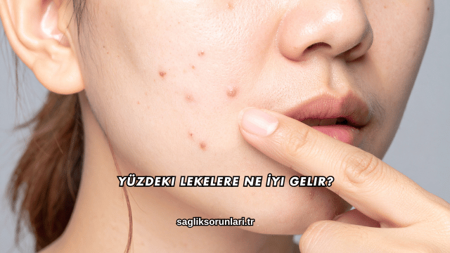 Yüzdeki Lekelere Ne İyi Gelir?