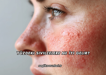 Yüzdeki Sivilcelere Ne İyi Gelir?