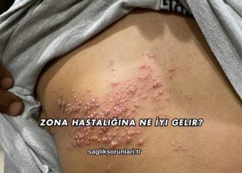Zona Hastalığına Ne İyi Gelir?