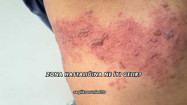 Zona Hastalığına Ne İyi Gelir?