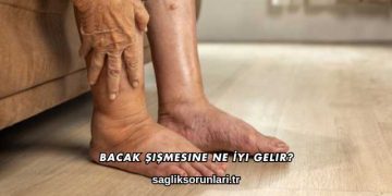 Bacak Şişmesine Ne İyi Gelir?