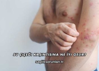 Su Çiçeği Kaşıntısına Ne İyi Gelir?